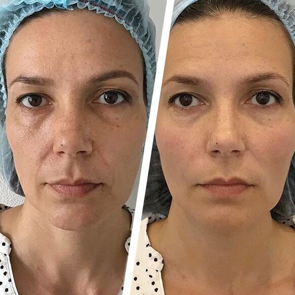 Rajeunissement au laser